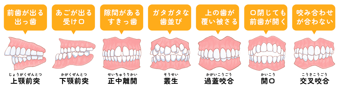 不正咬合