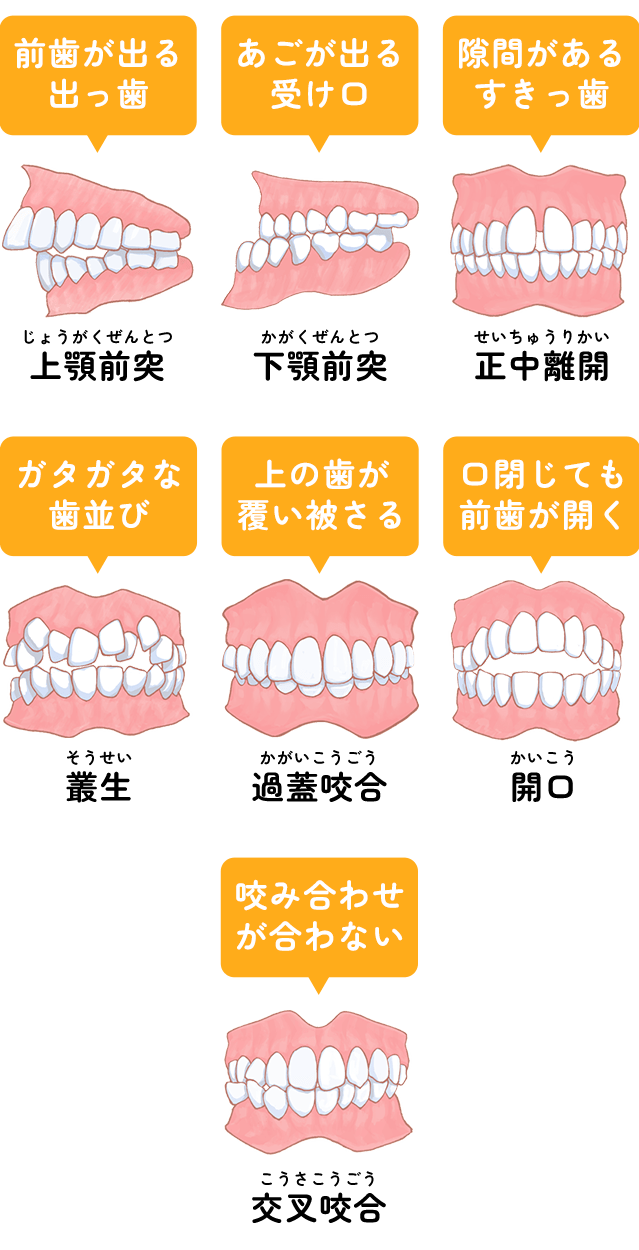 不正咬合