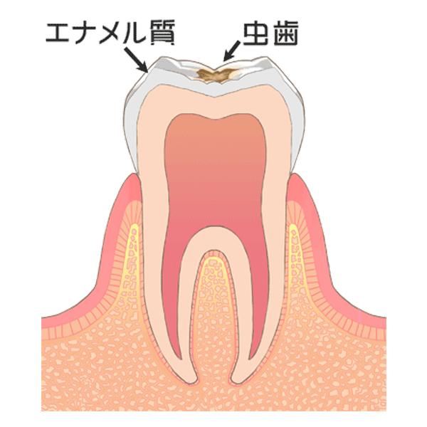 Ｃ１：歯の表層（エナメル質）の虫歯