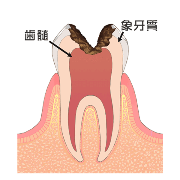 Ｃ３：神経まで達した虫歯
