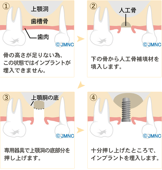 ソケットリフト法