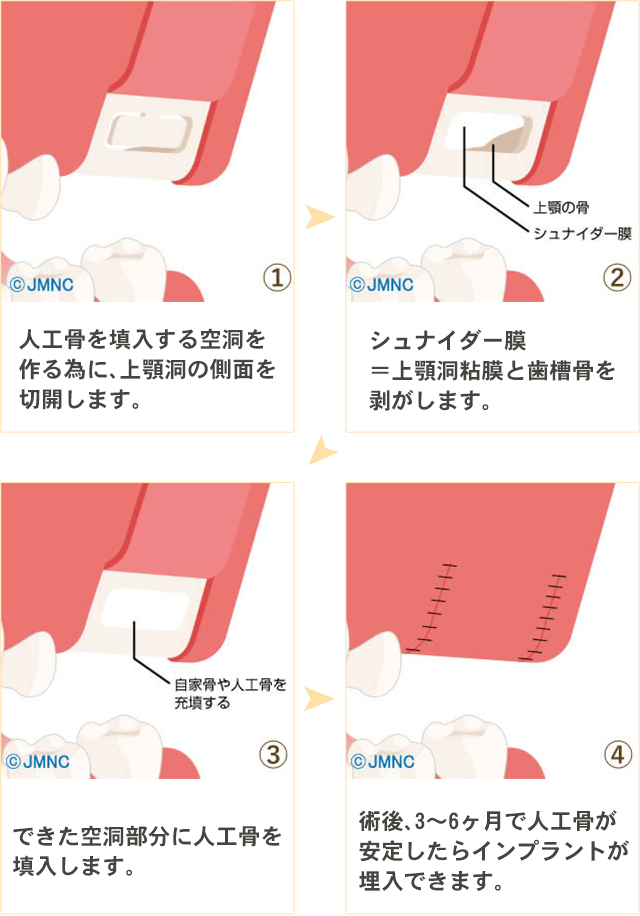 サイナスリフト法